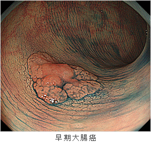 早期大腸癌