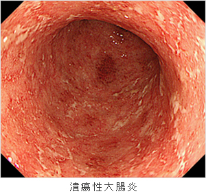 潰瘍性大腸炎