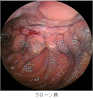 クローン病