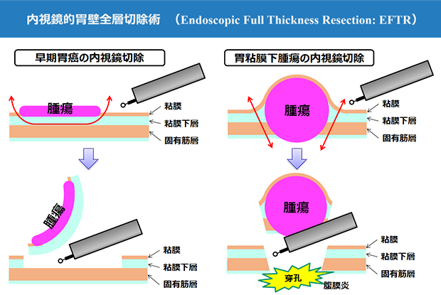 早期胃癌の内視鏡切除、胃粘膜下腫瘍の内視鏡切除