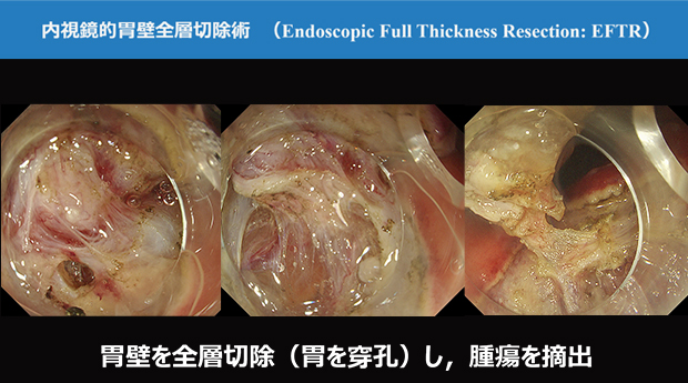 胃壁を全層切除（胃を穿孔）し腫瘍を摘出