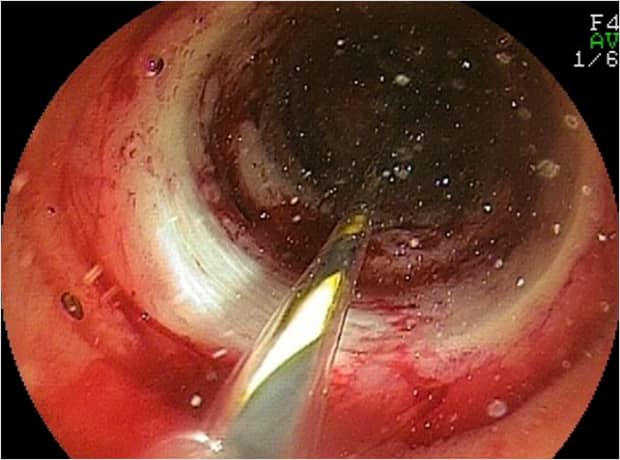 ダブルバルーン小腸内視鏡画像